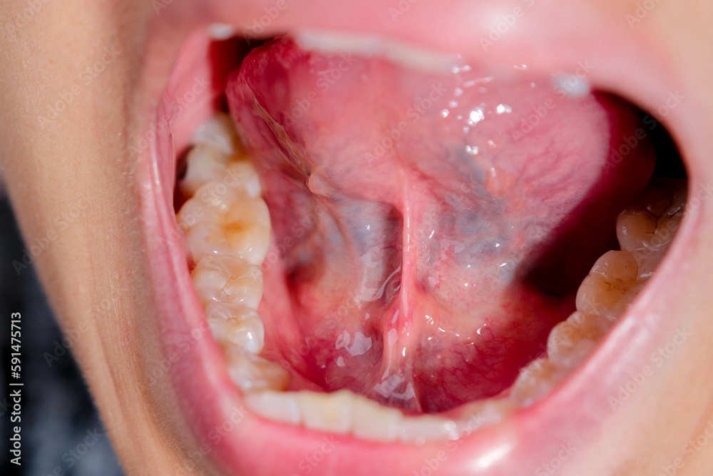 The importance of maintaining a healthy lower palate for overall well-being