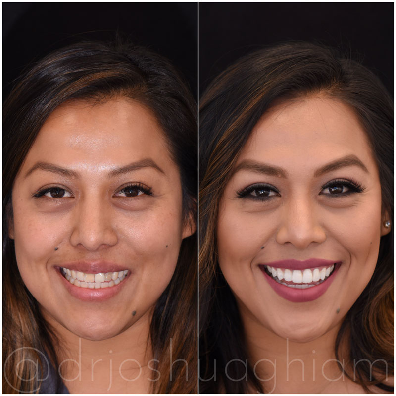 12 Tooth Smile – How to Achieve a Perfectly White and Healthy Smile