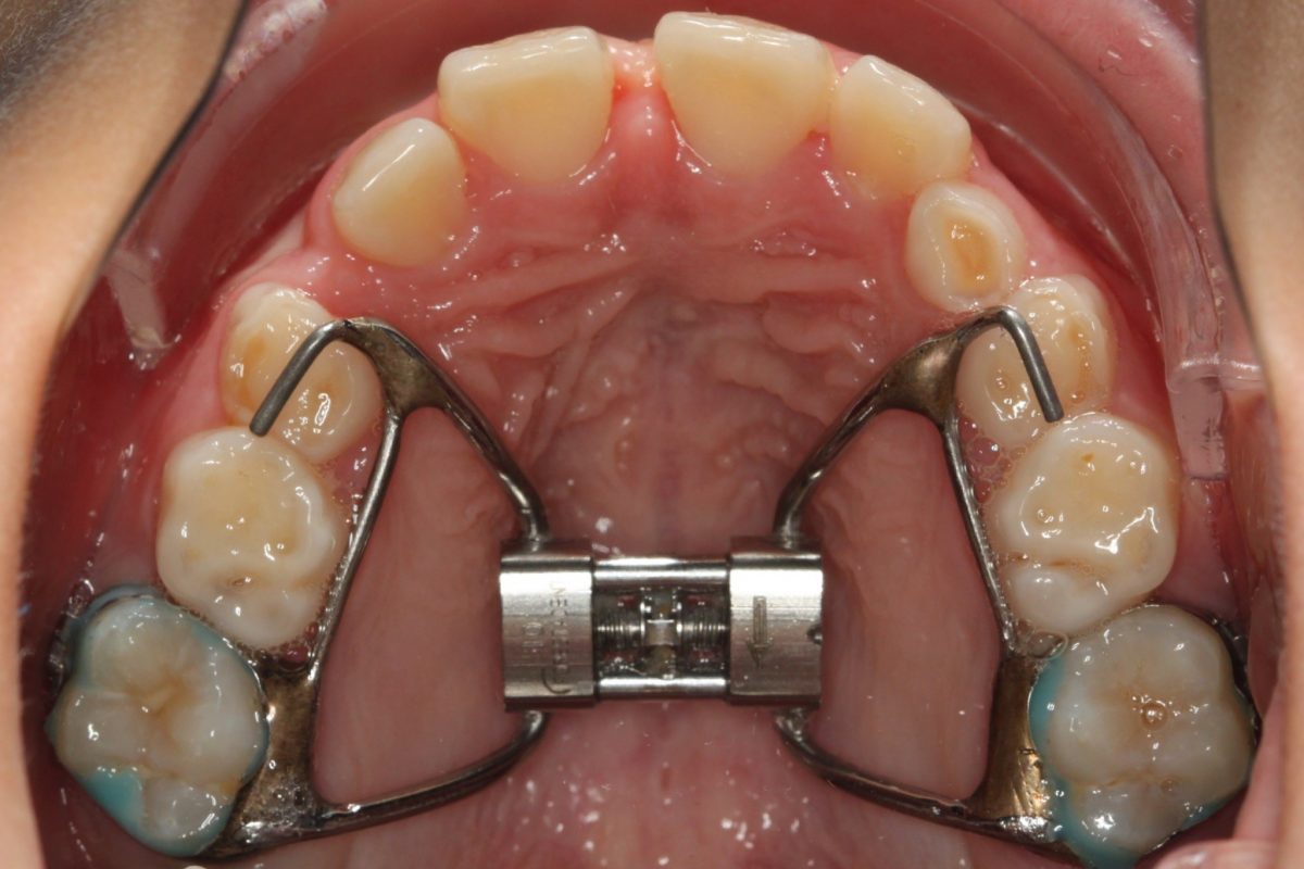 What Does an Expander Do? Everything You Need to Know