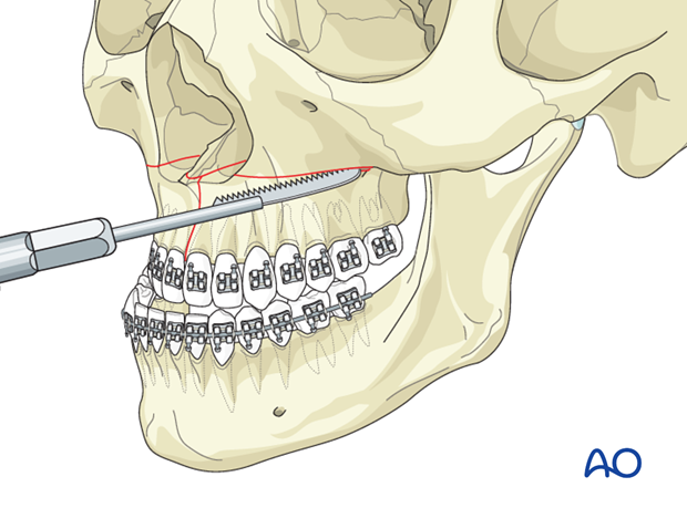 Palate Expansion Surgery – Understanding the Procedure, Benefits, and Recovery