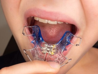 Dental Expander for Child – A Comprehensive Guide to Understanding the Benefits and Usage