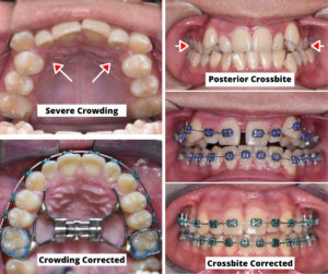 Amazing Transformations – Jaw-Dropping Palate Expander Before and After Results