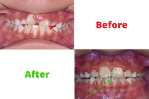 Expander Treatment – Can It Really Create a Gap in Your Teeth?