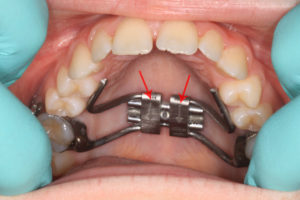 Metal Object on the Roof of Your Mouth – Causes, Symptoms, and Treatment
