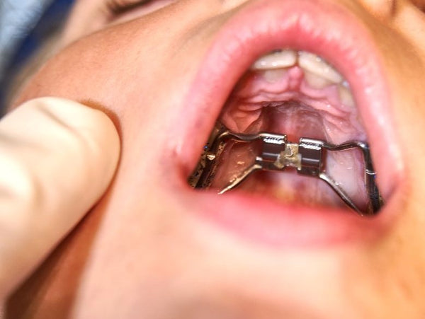 Step-by-Step Guide – How to Clean a Palate Expander and Maintain Oral Hygiene