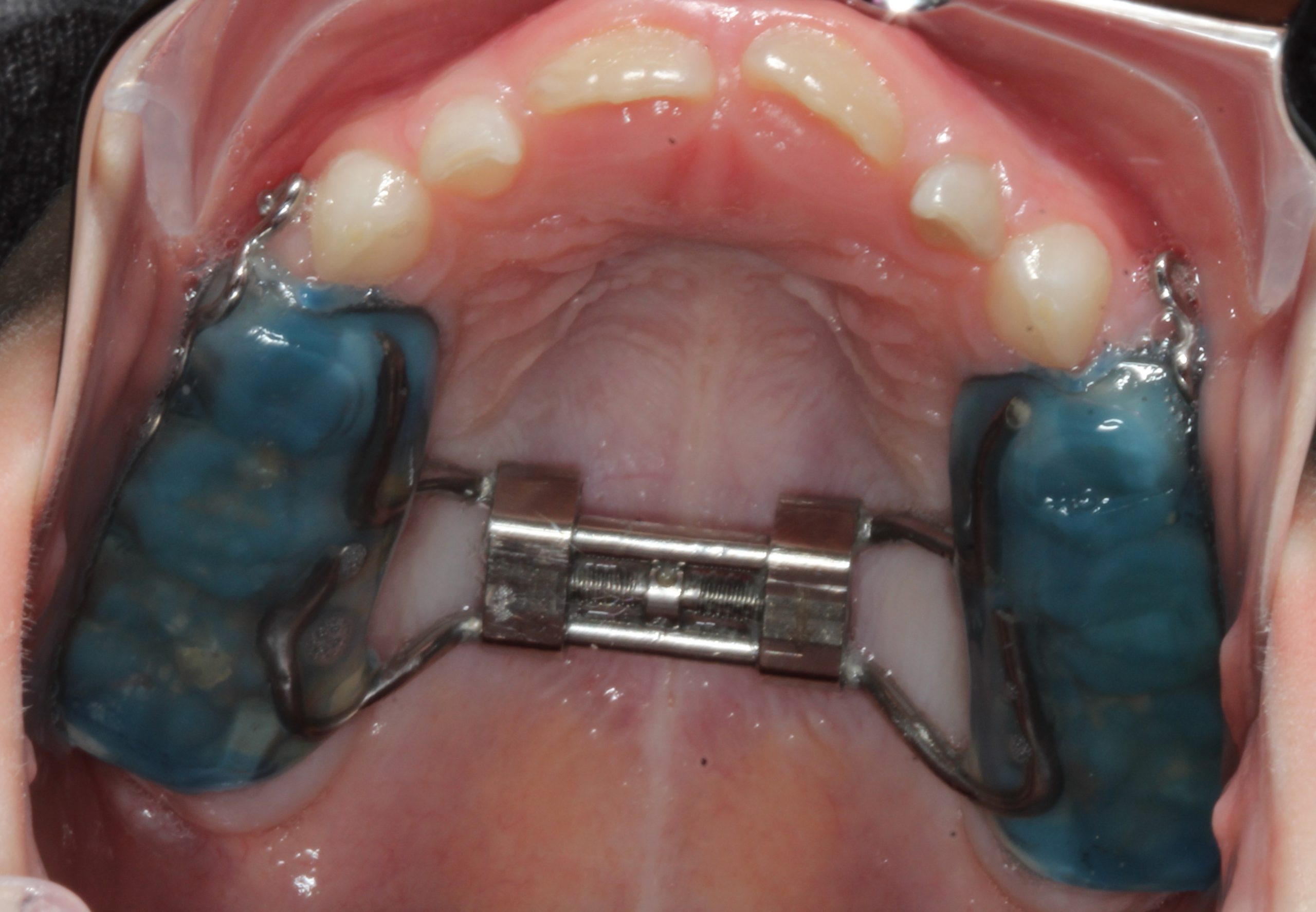 Understanding the Different Types of Palatal Expanders for Orthodontic Treatment