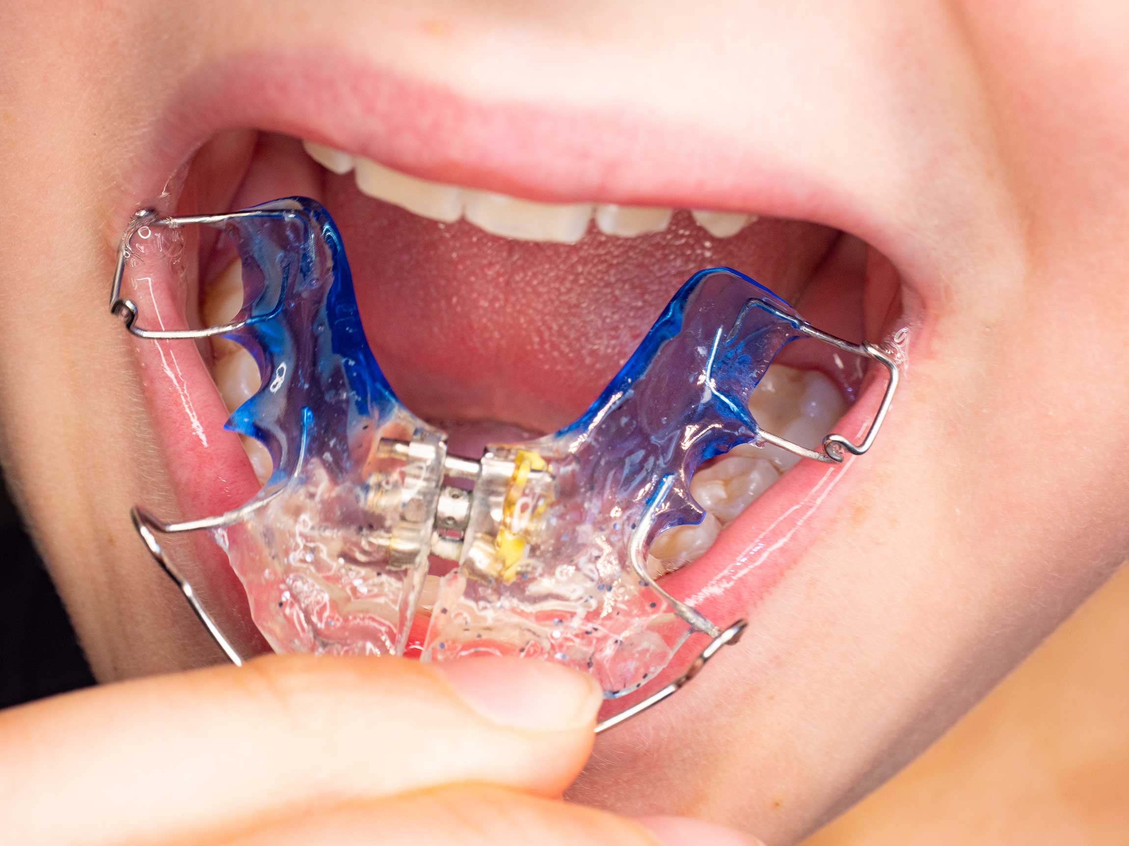 The Importance of Dental Palate in Maintaining Oral Health and Overall Well-being