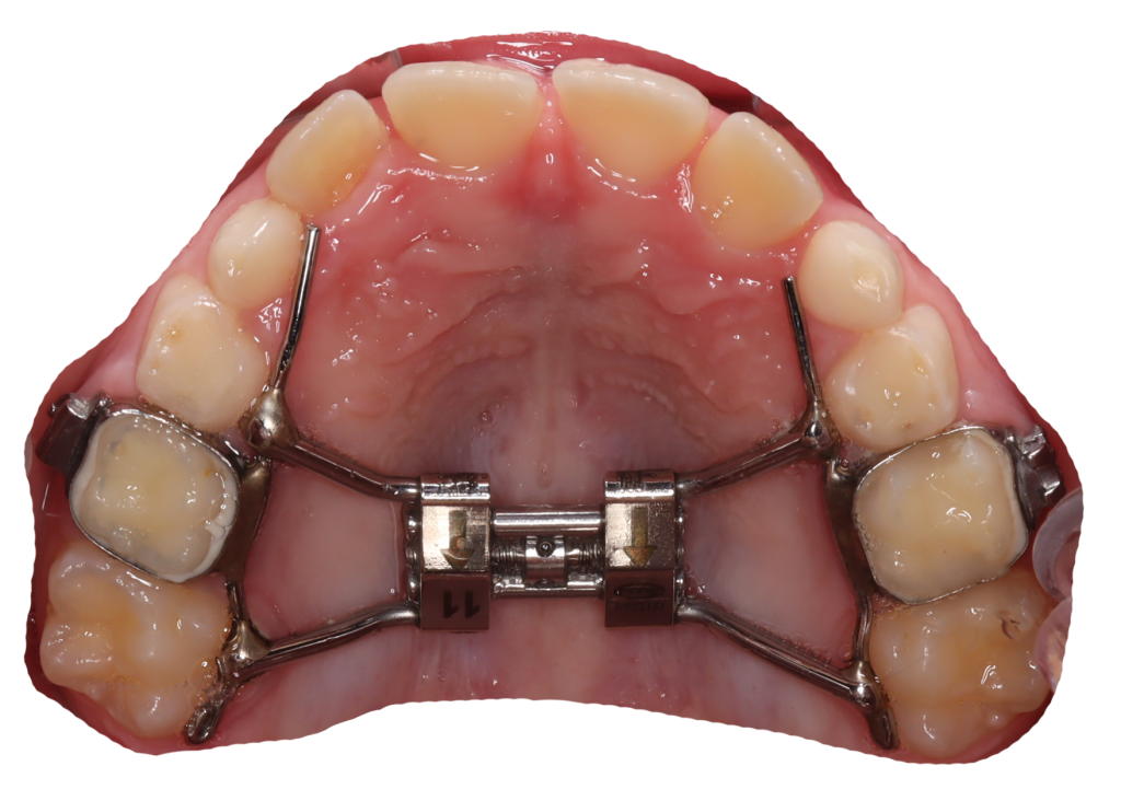 What You Need to Know About Lower Teeth Expander – A Comprehensive Guide