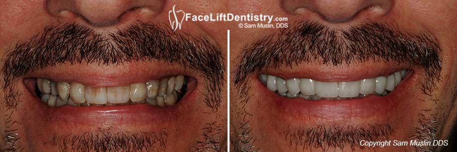 Get a Brighter Smile with Wider Teeth Today!