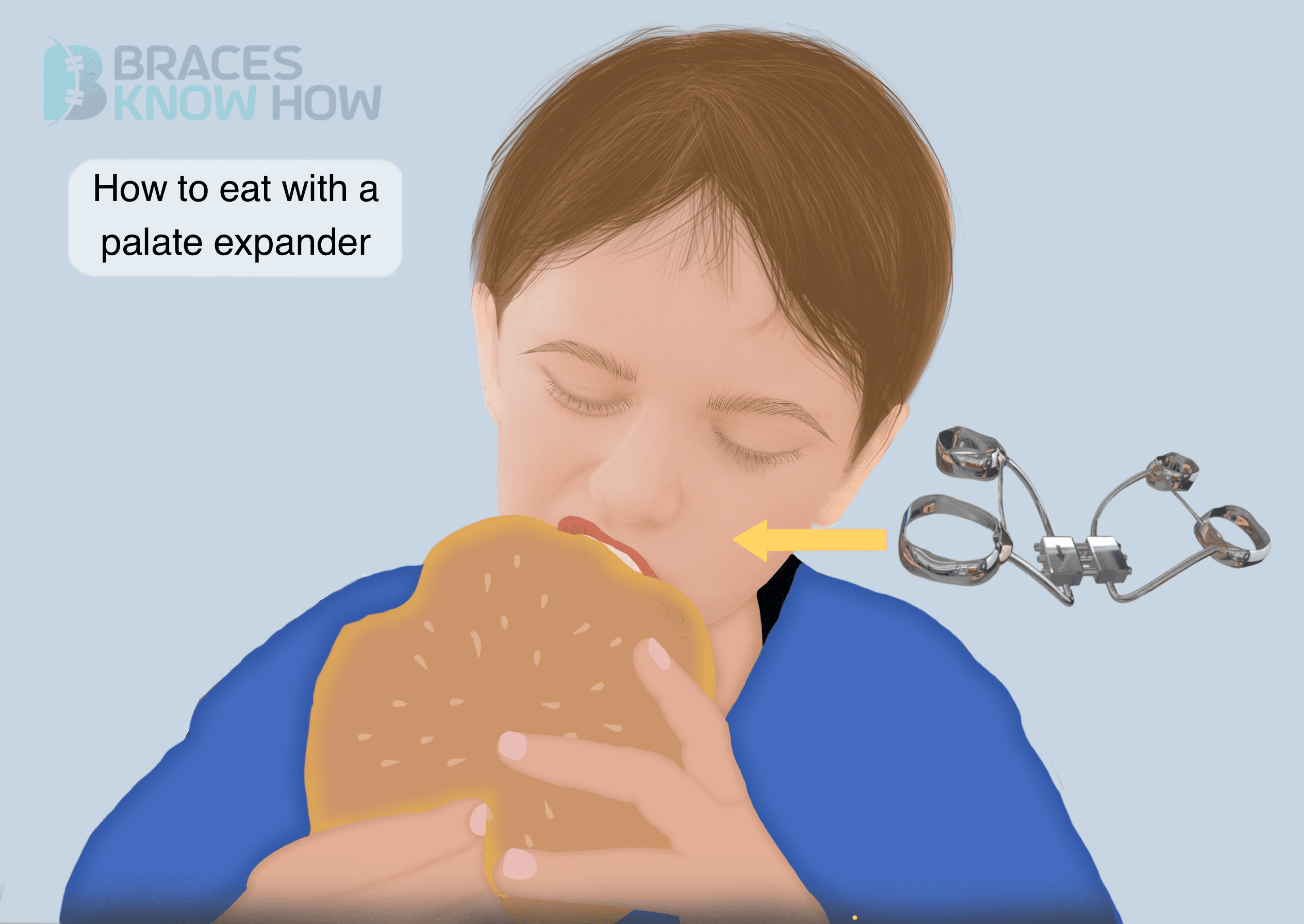What Foods Should You Avoid While Wearing an Expander?