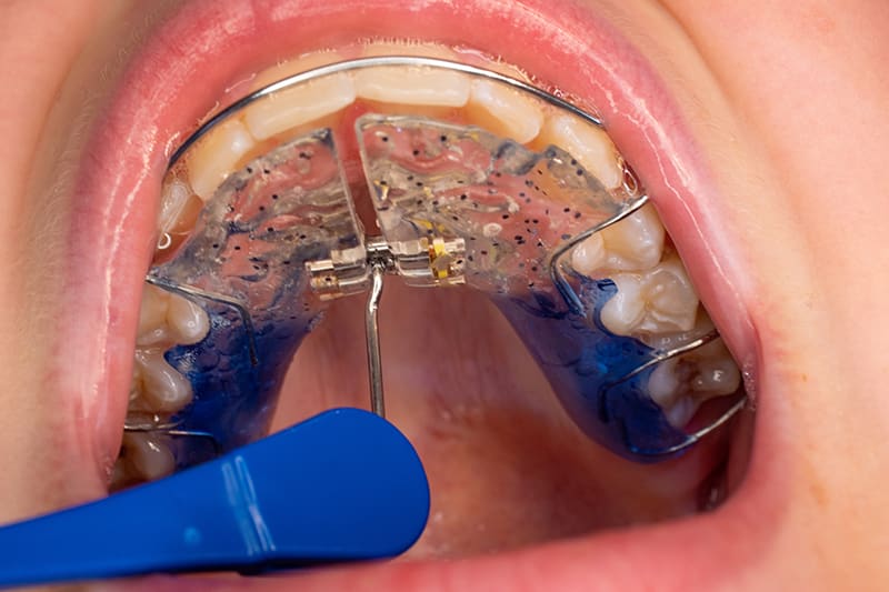 Expander Braces – A Comprehensive Guide to Understanding and Using Them for Enhanced Functionality
