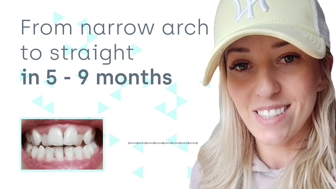 Can Invisalign Expand the Dental Arch?
