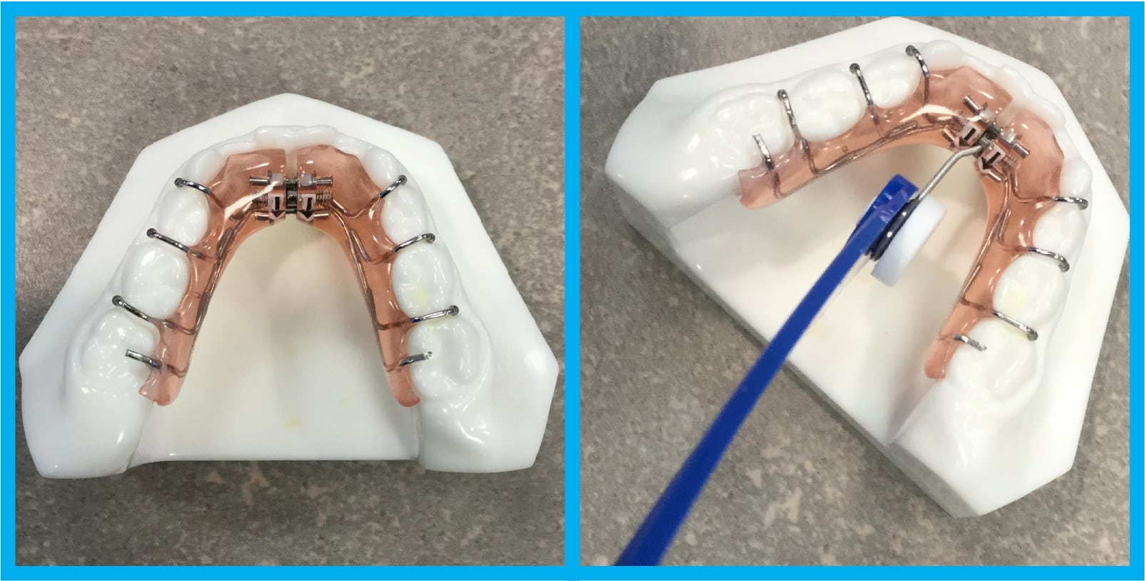 Step-by-Step Guide on How to Properly Use an Expander for Dental Treatment