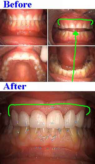 Transform Your Smile with a Bite Plate – Before and After