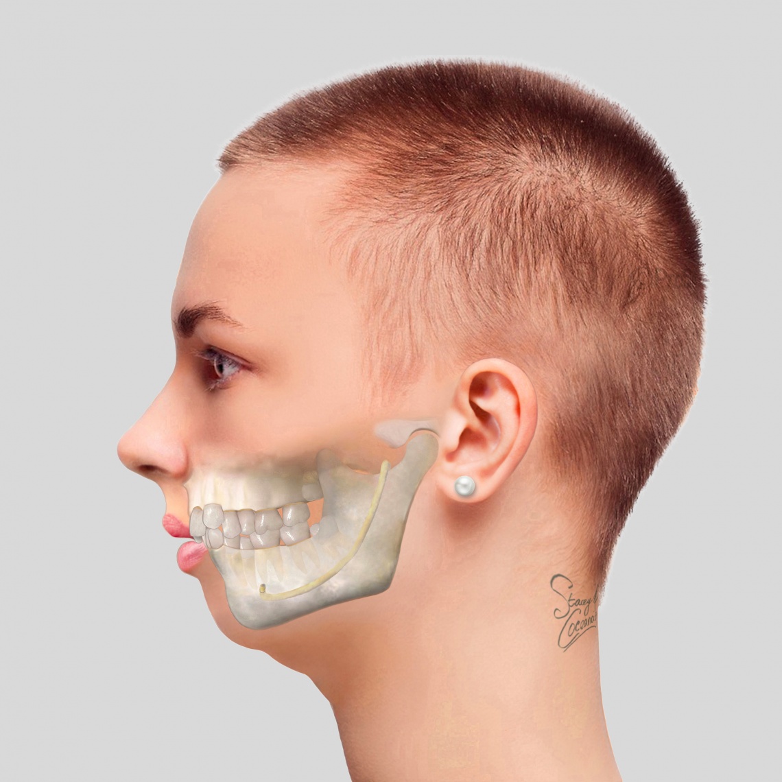 Upper Jaw Expansion Surgery – A Comprehensive Guide to Correcting Dental and Orthodontic Issues
