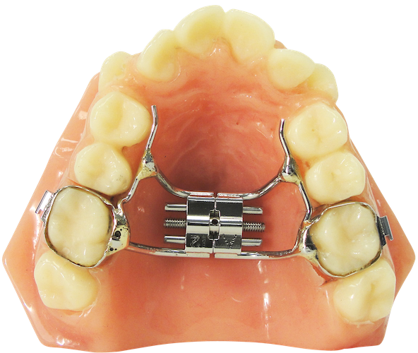 Understanding the Role of RPE in Orthodontics – A Comprehensive Guide