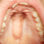 Tooth in the Palate of the Mouth - Causes, Symptoms, and Treatment Options