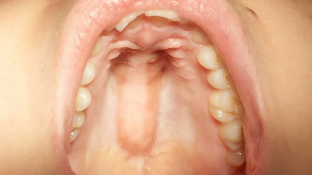 Tooth in the Palate of the Mouth – Causes, Symptoms, and Treatment Options